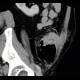 Crohn's disease, fistulising form, fistula in abdominal wall: CT - Computed tomography
